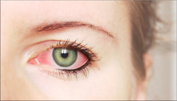 Что делать если у вас красные глаза после сна: 18 причин + когда обращаться к окулисту
